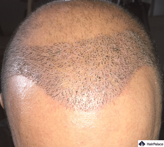 Xavier 1 week after his hair implantation