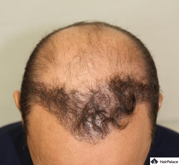 Xavier's result of the 1st hair transplant