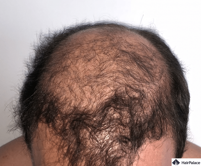 Xavier 3 months after hair implantation