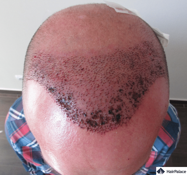 Xavier FUE2 hair transplant