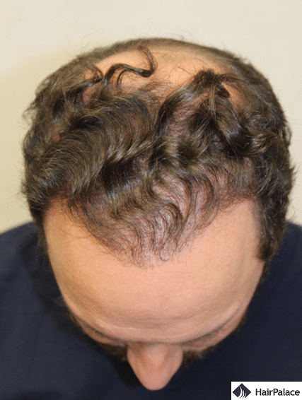 Xavier's result after the 2nd hair transplant