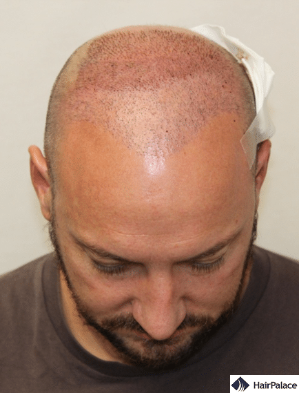 Xavier's second hair transplant