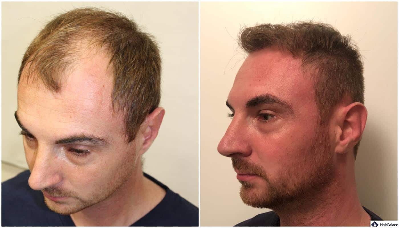 before and after the fue hair transplant