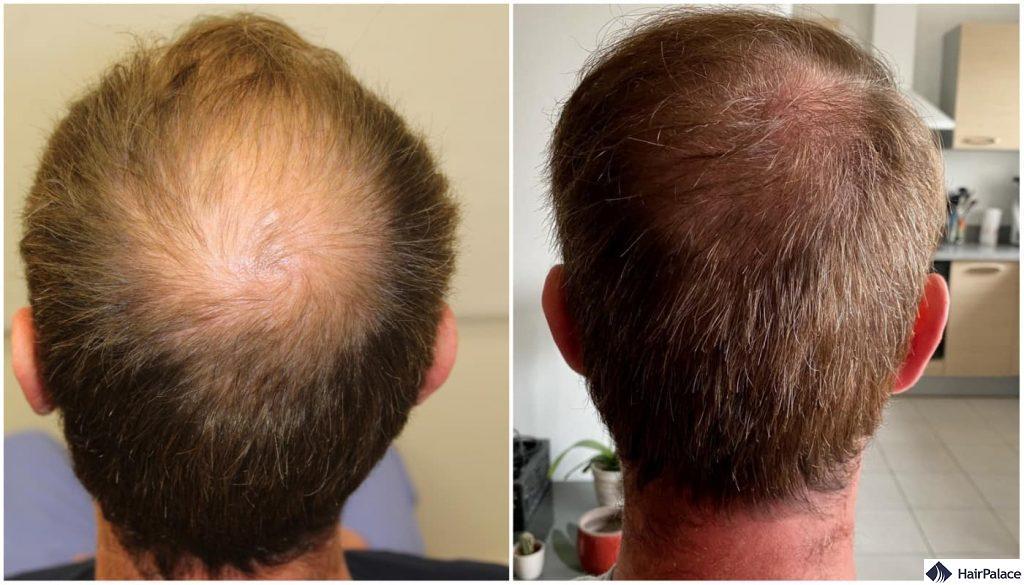 result of the second hair transplant at the crown in Alex's case,