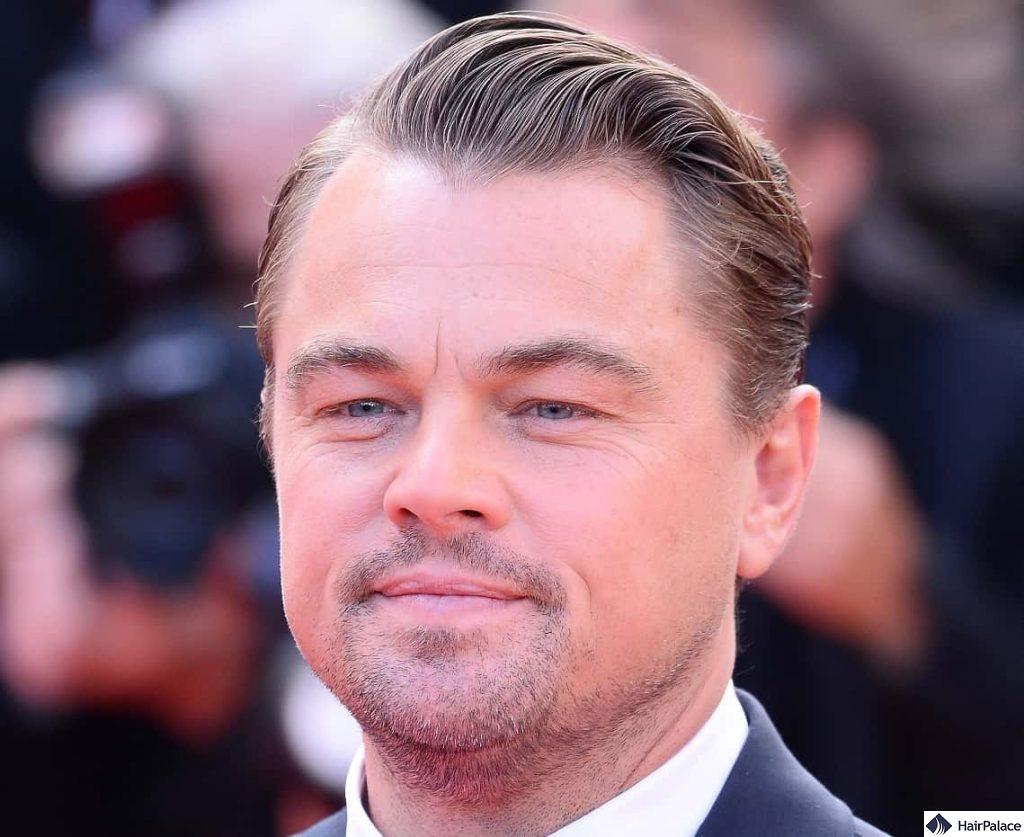 Receding hairline: symptoms, stages, causes, and treatment options