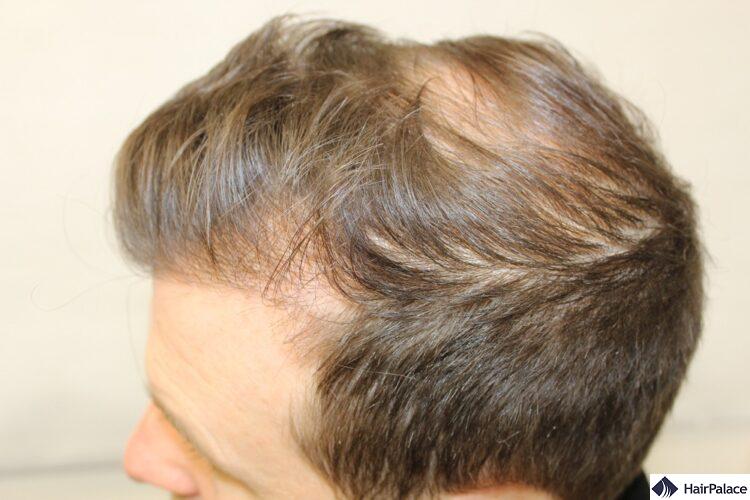 Peter's consultation before his FUE2 hair transplant