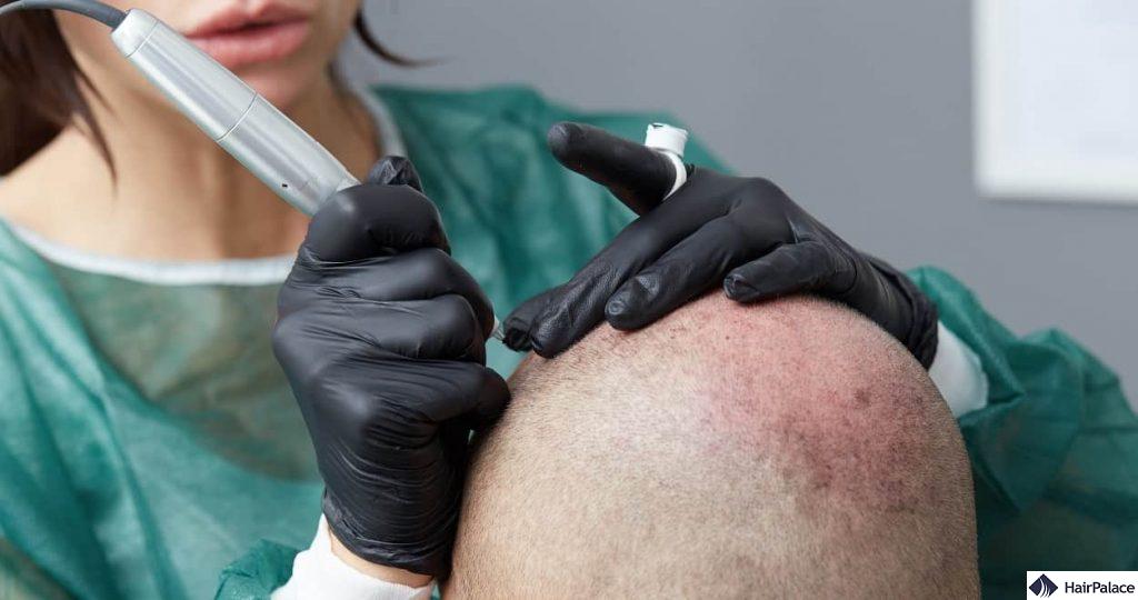 Scalp Micropigmentation Benefits