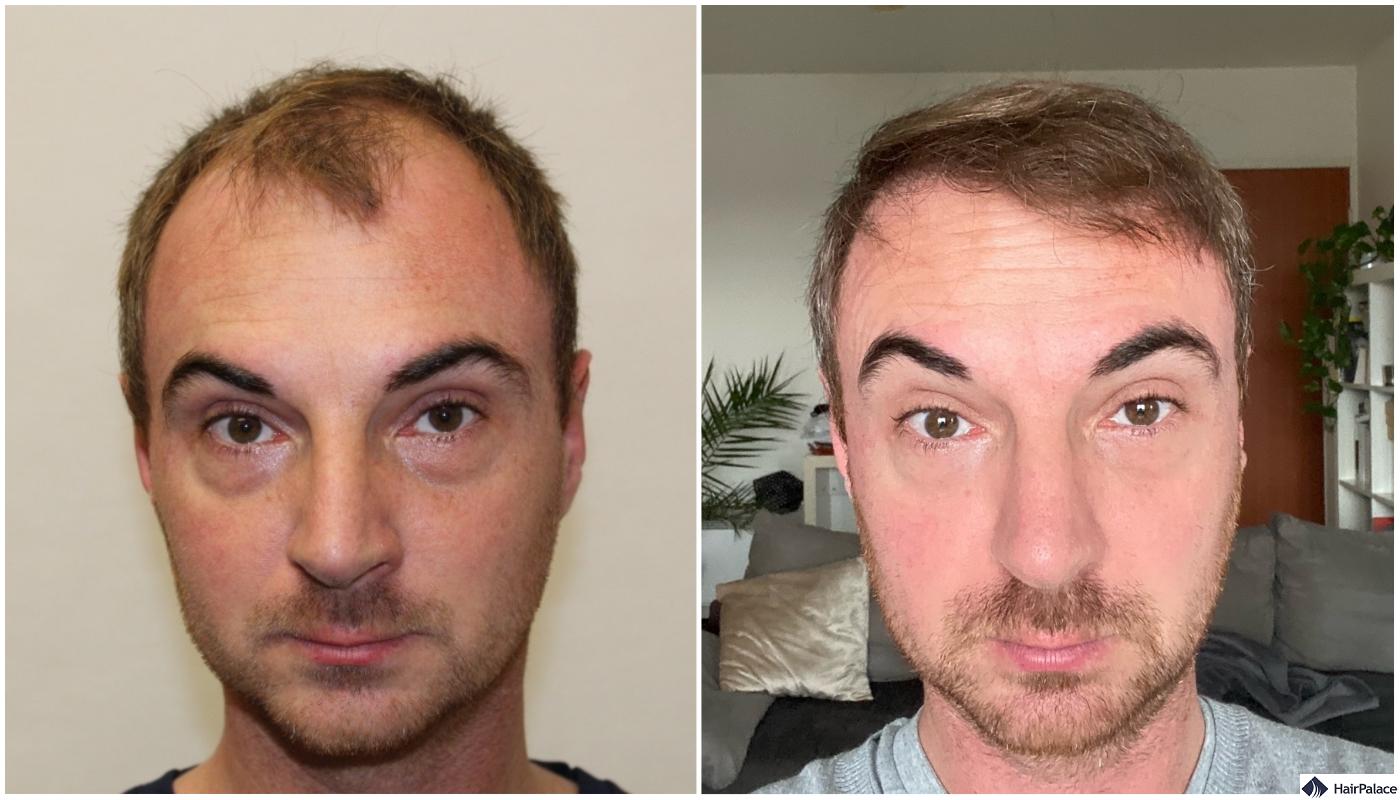 Result of hair restoration