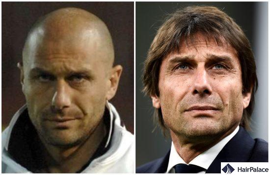 Antonio Conte before and after FUE2 hair transplant