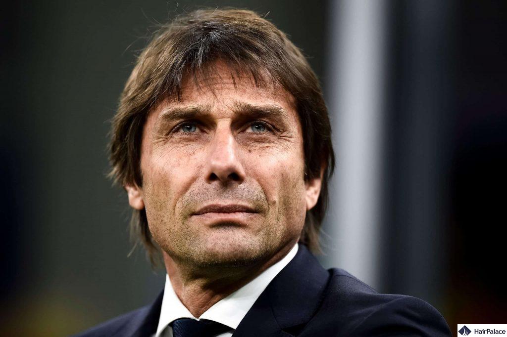 Antonio Conte before and after FUE2 hair transplant
