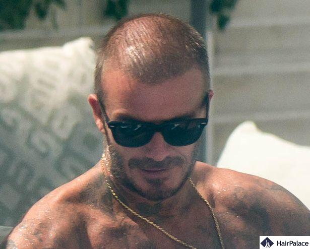 David Beckham hair loss in his 40s