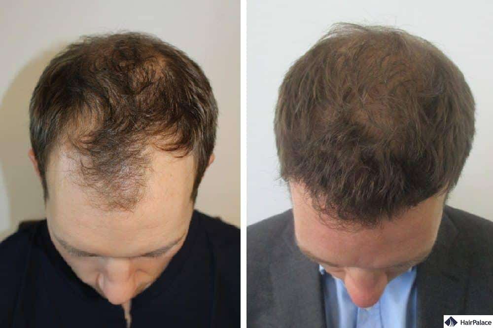 FUE hair transplant surgery with dense result