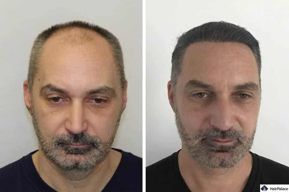 fue hair transplantation at hairpalace