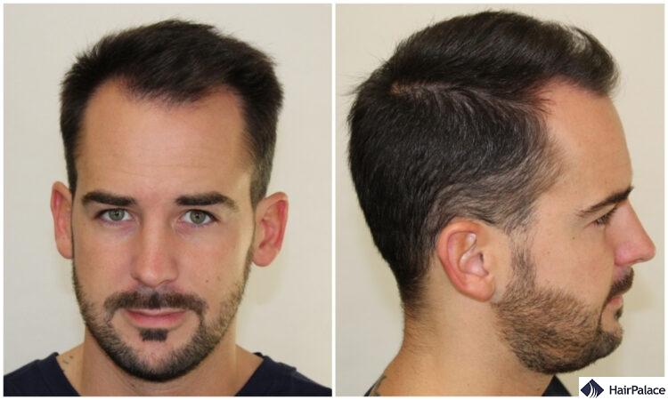 Maxim before after his hair transplant