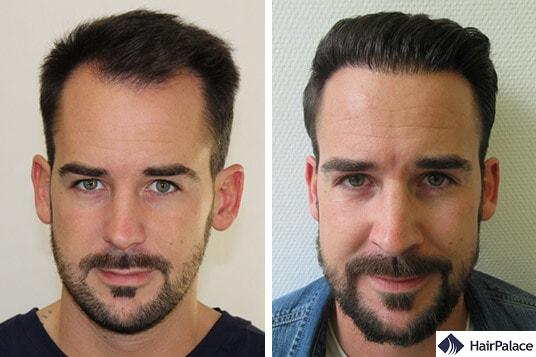 Maxim's successful hair transplant