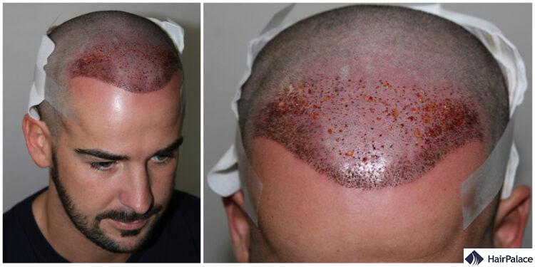 Maxim's FUE2 hair restoration