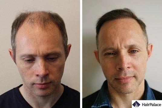 natural fue hair transplant result