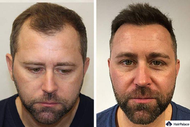 Hair Transplant USA TOP 10 Clinics in 2024