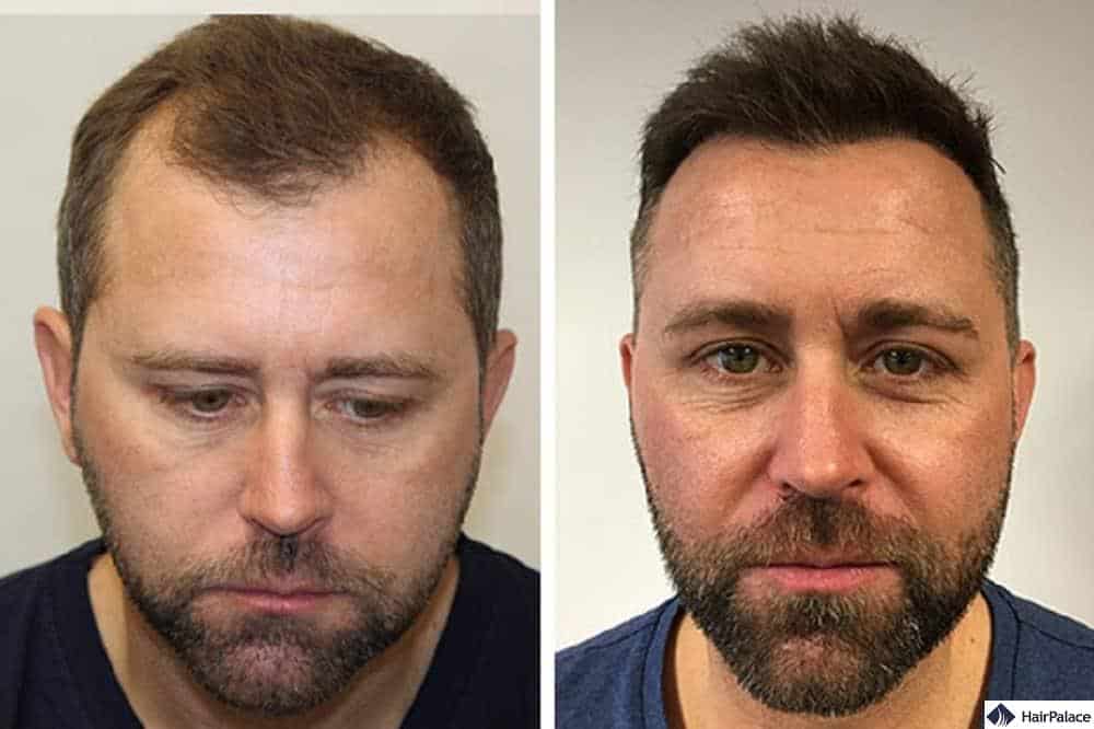 How Much Does a Hair Transplant Cost (Update for 2023) - HairScience