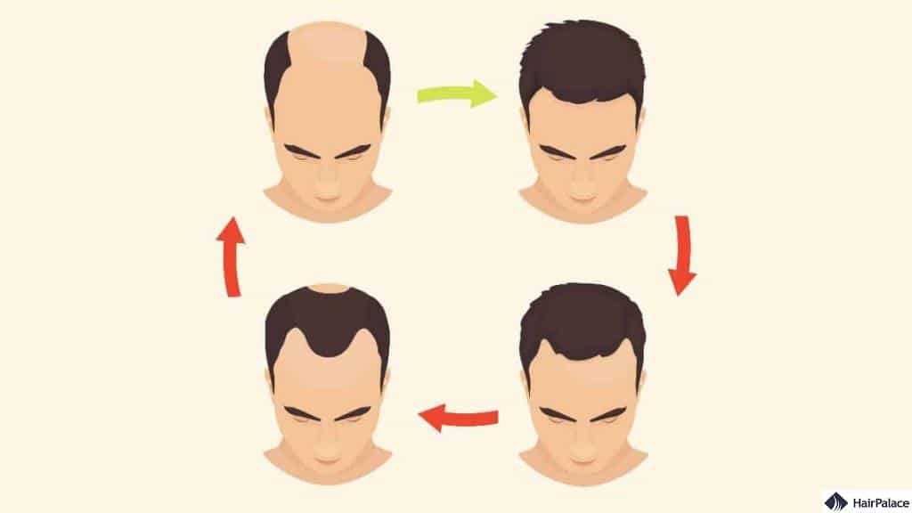 the norwood scale to classify your baldness