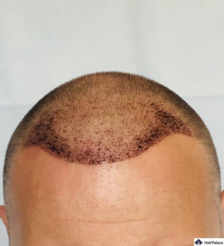 paul 1 week result after fue2 hair transplant