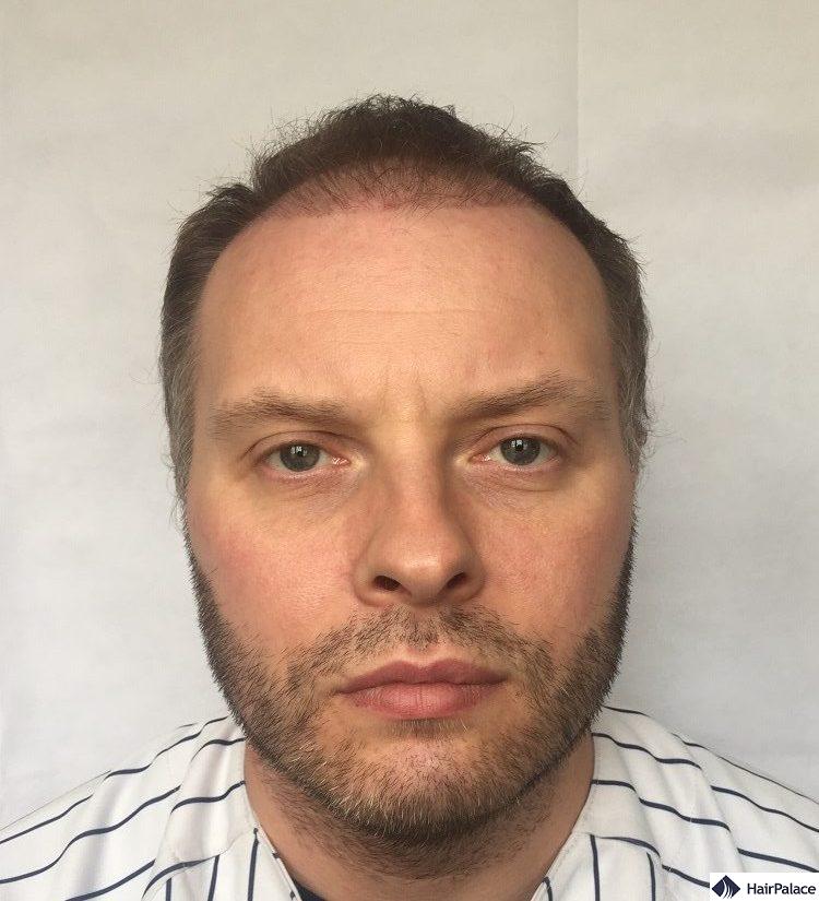 Paul 3 months hair transplant result