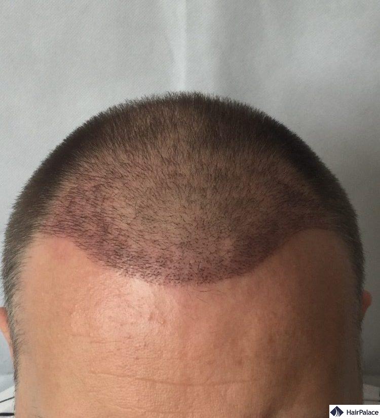 paul 3 weeks hair transplant