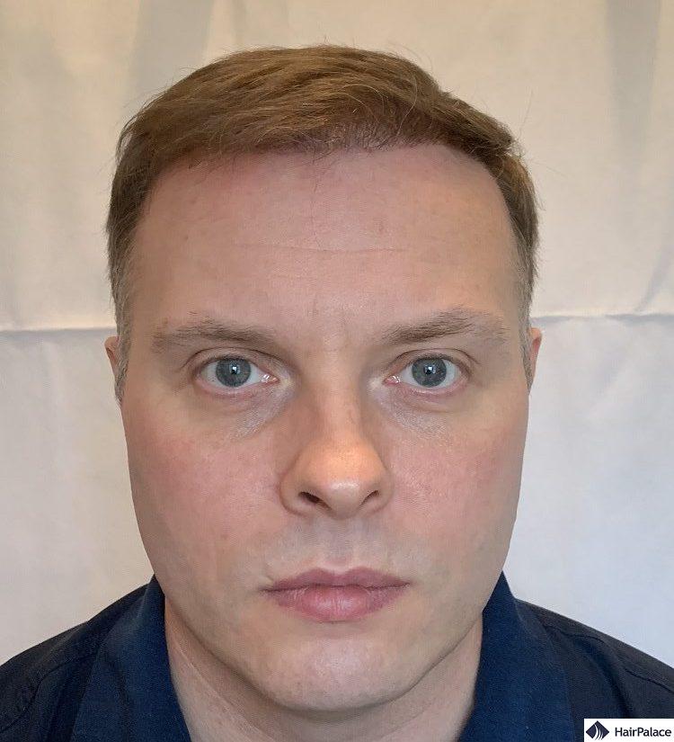 Paul 6 months hair restoration result