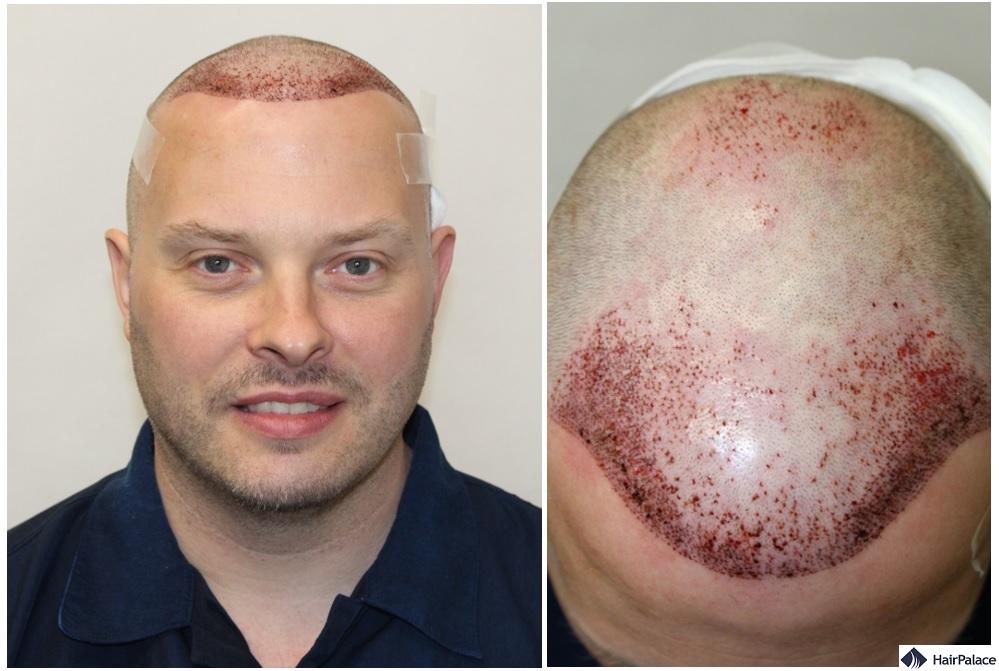 Paul hair transplant surgery