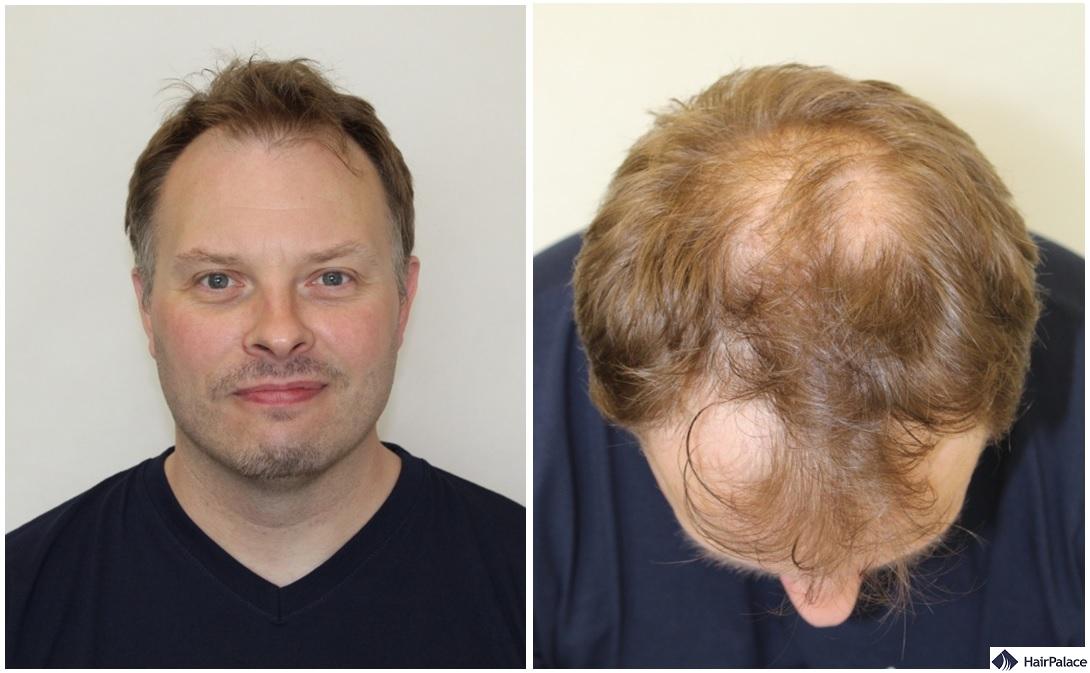 Paul in his hair transplant consultation