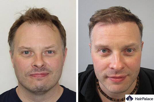 FUE2 hair transplant result before after Paul