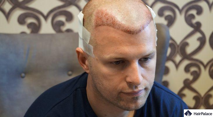 Peter's FUE2 hair transplantation