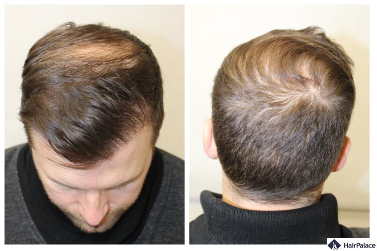 Peter's pattern baldness before the FUE2 surgery