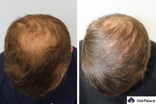 Successful hair transplant Peter