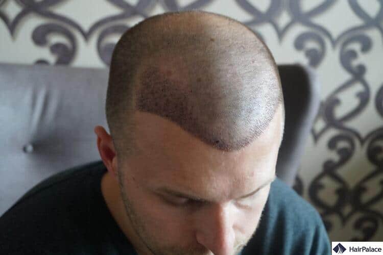 Peter just one week after his hair transplant