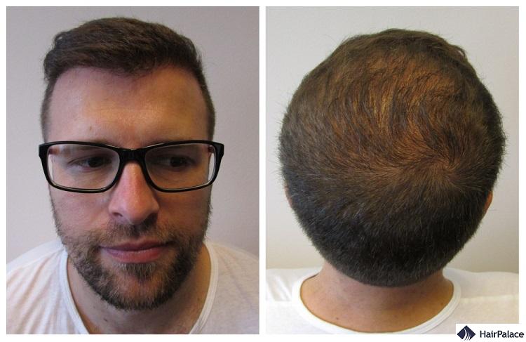 Peter's 1 year hair implantation result