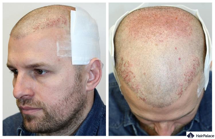 Peter's 2nd FUE2 treatment