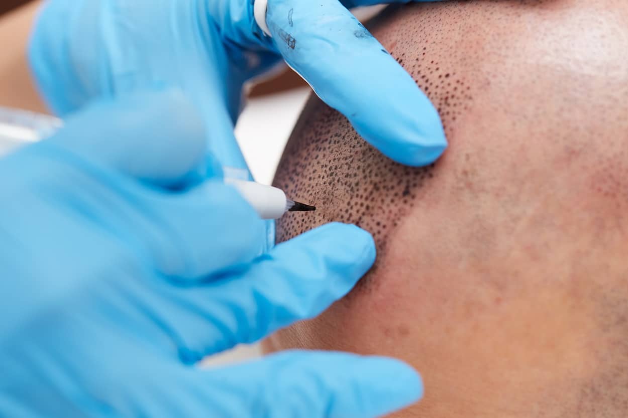 scalp micropigmentation with an electric tattoo device 