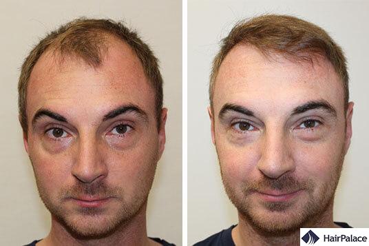 Alex hair transplant result