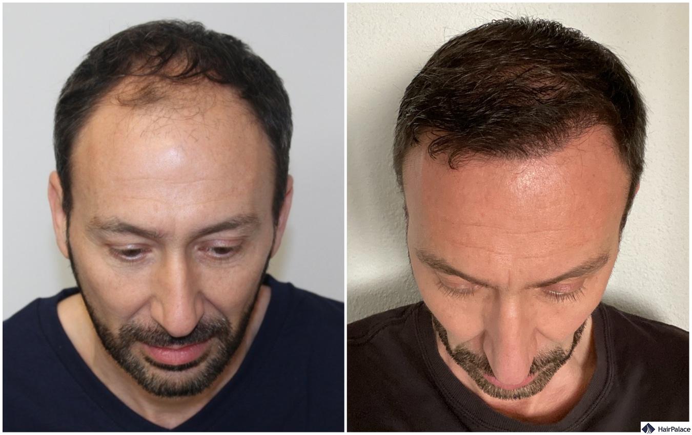 hair transplant result in Brentwood