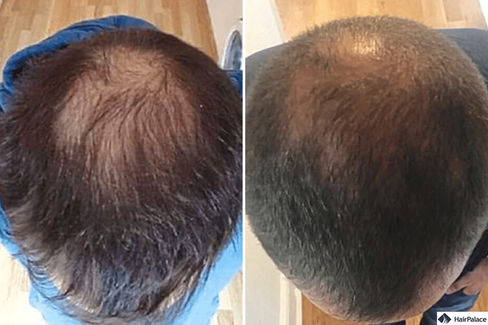 hair transplant stem cell uk surgery