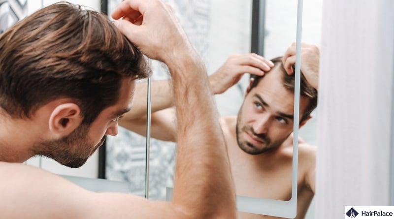 balding signs hair loss