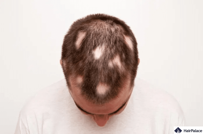 patchy hair loss is a common symptom of alopecia areata