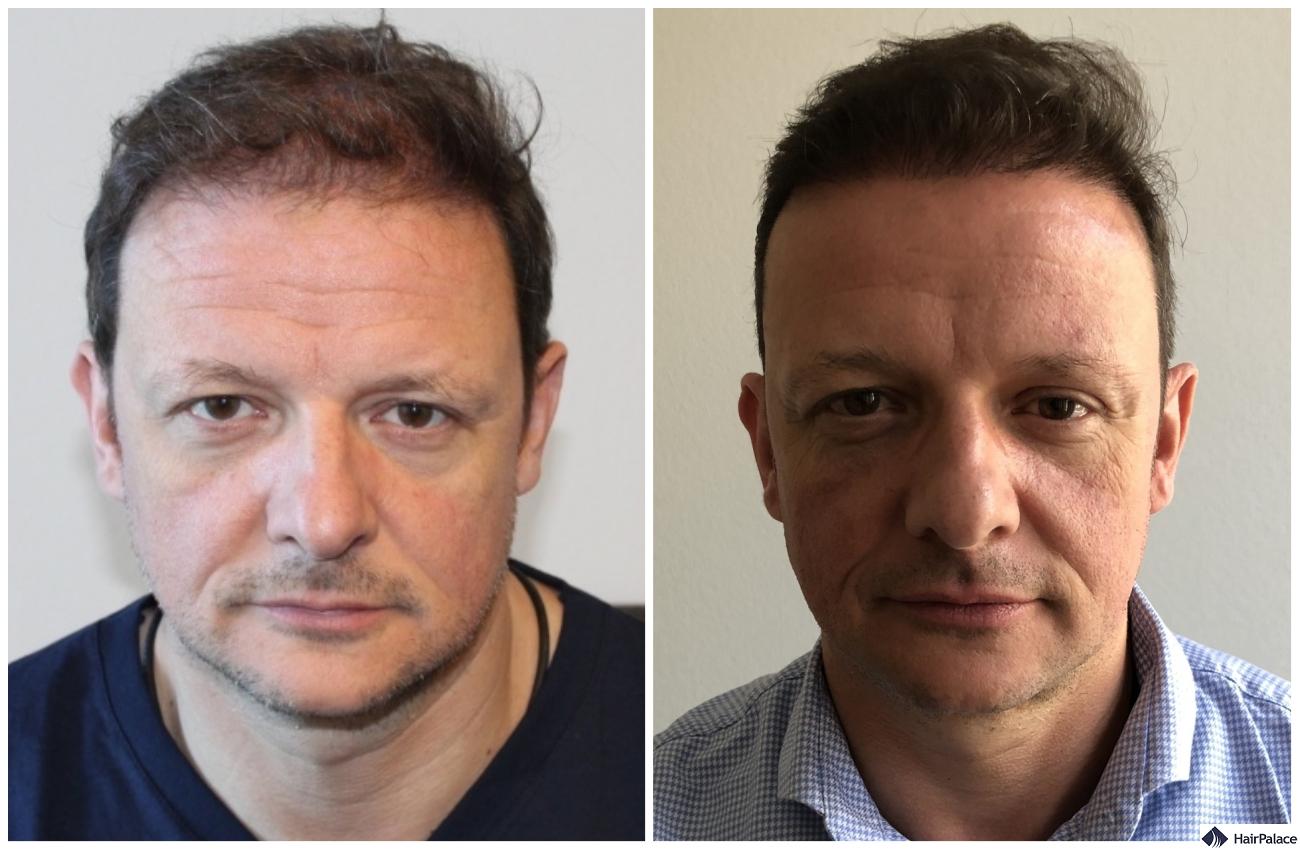 natural result with hair transplant in andover