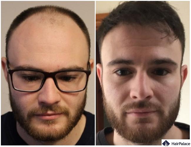 hair transplant result in Andover