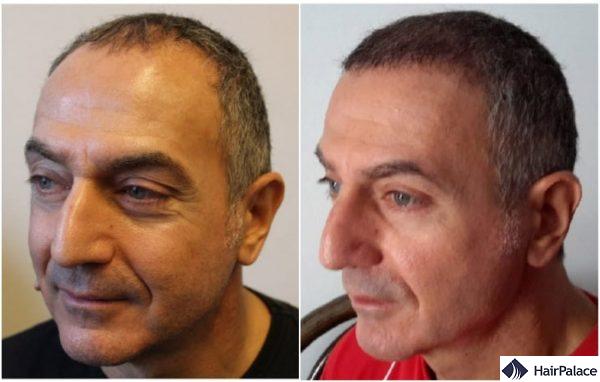 hair transplant result in Aylesbury