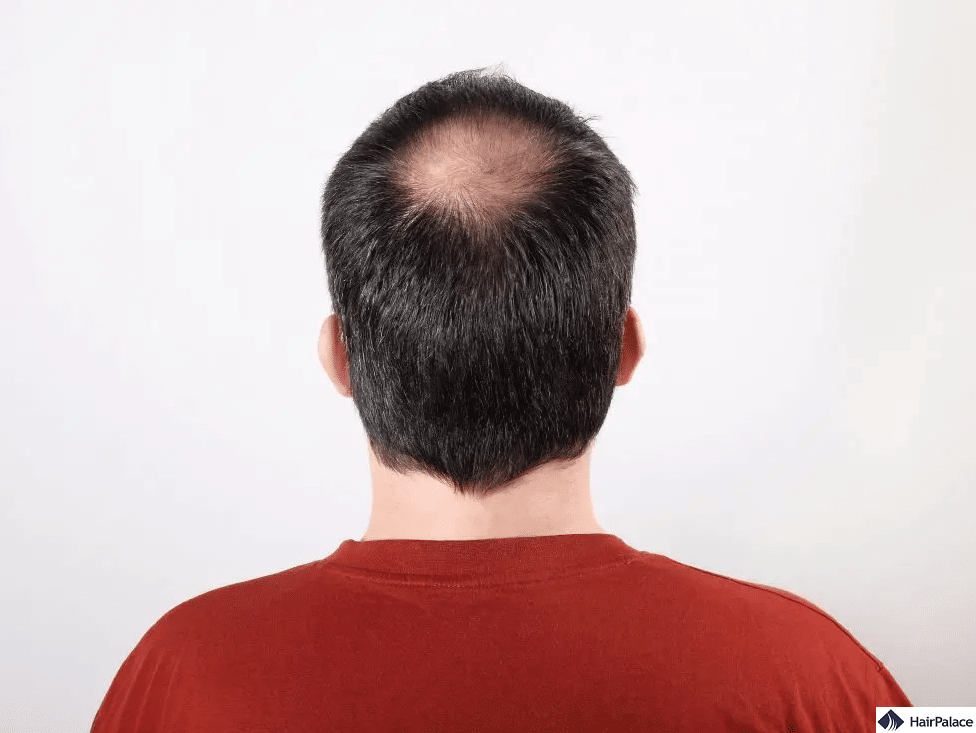 20 Cool Hairstyles for Men with Thinning Hair on Crown