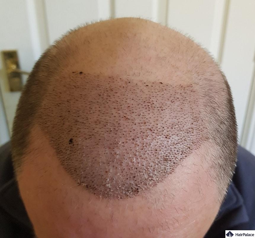 Scabs 1 week after the hair transplant