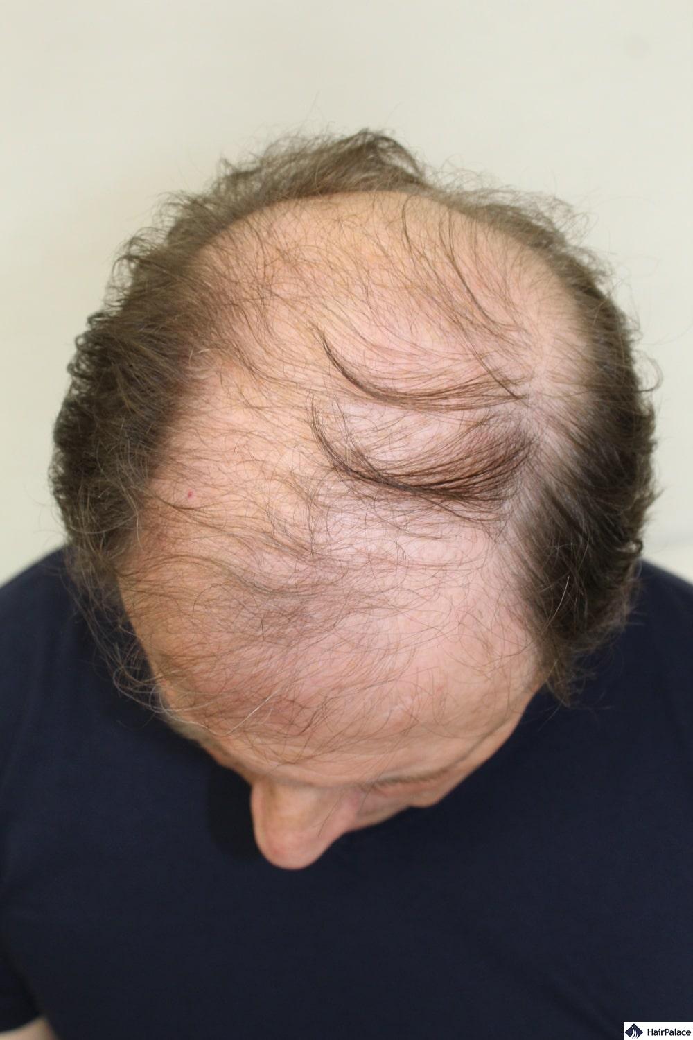 Derek baldness before hair transplant