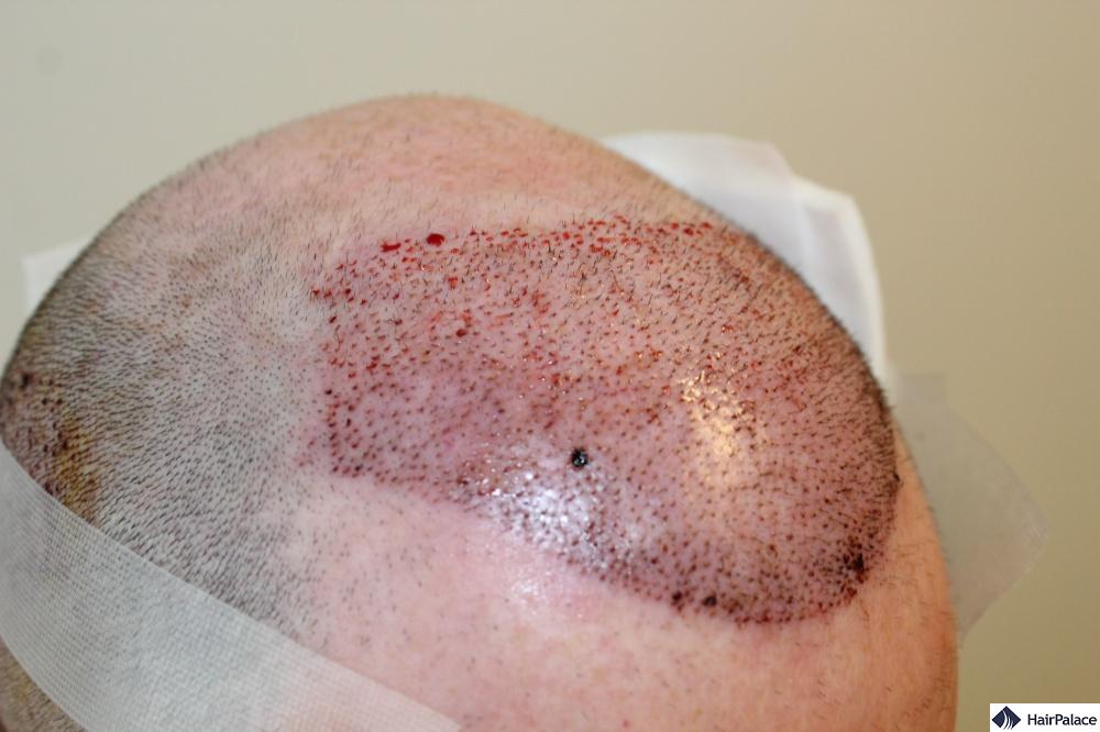 After FUE2 hair transplant surgery